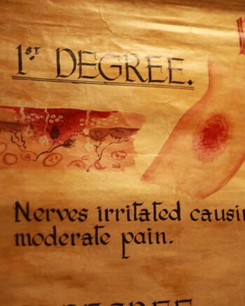 Hand-painted Burns Medical Chart