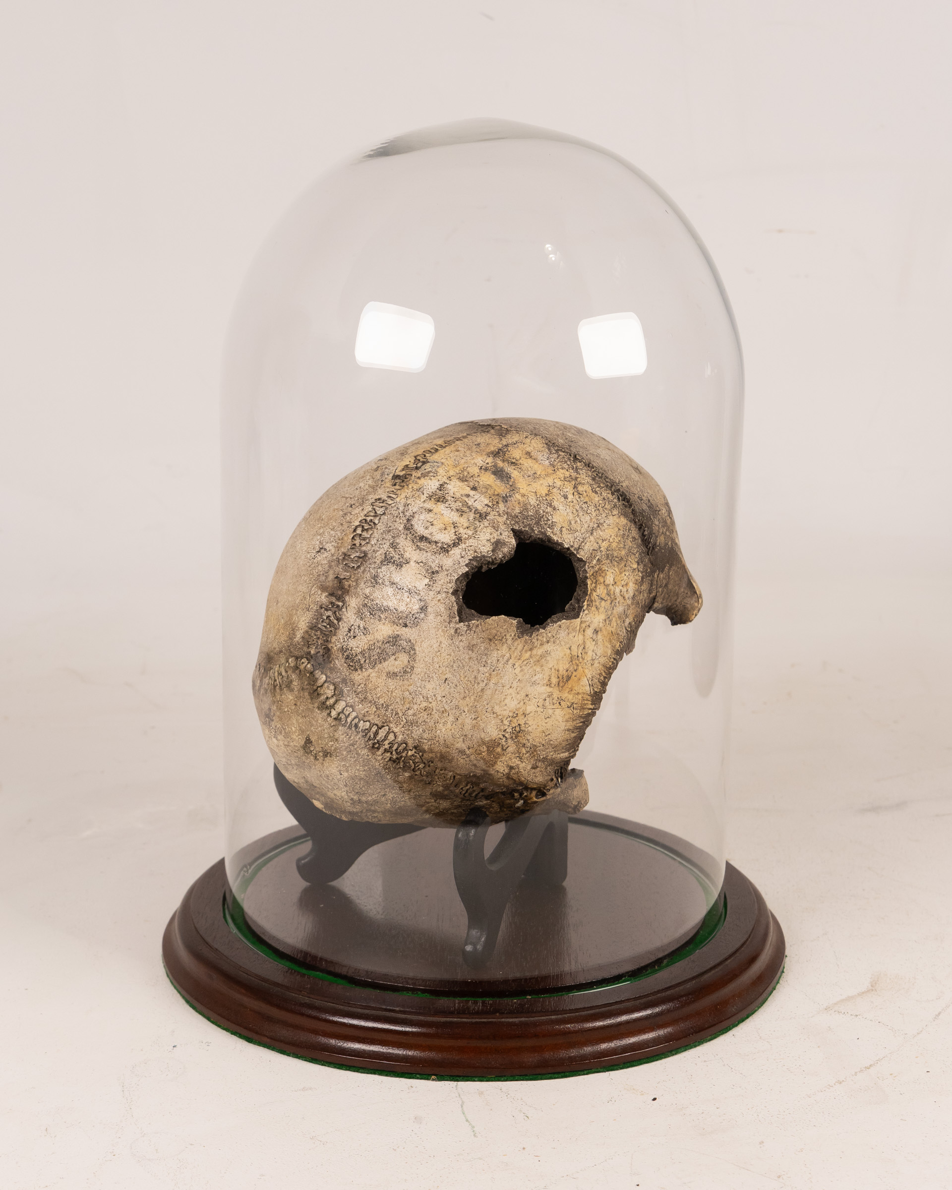 Victorian Pathology Human Skull Marked “Suicide” in Glass Dome