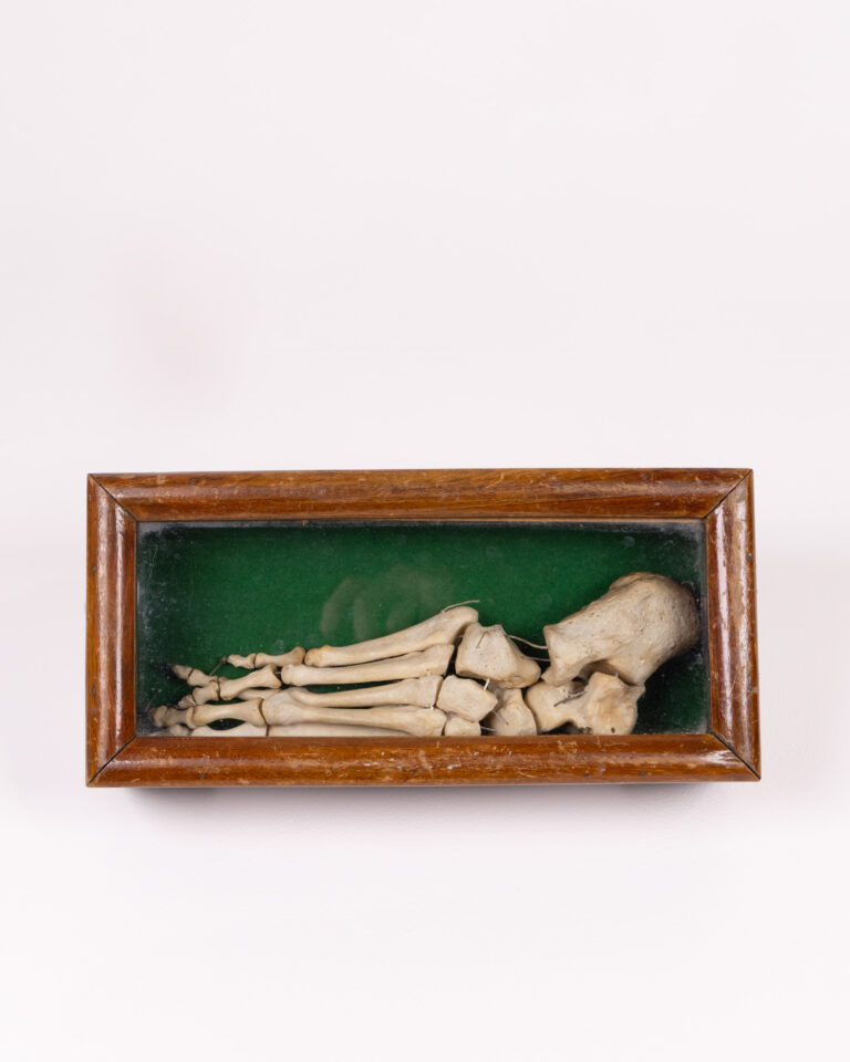 Victorian Human Bone Foot Skeleton Display with Glass Case