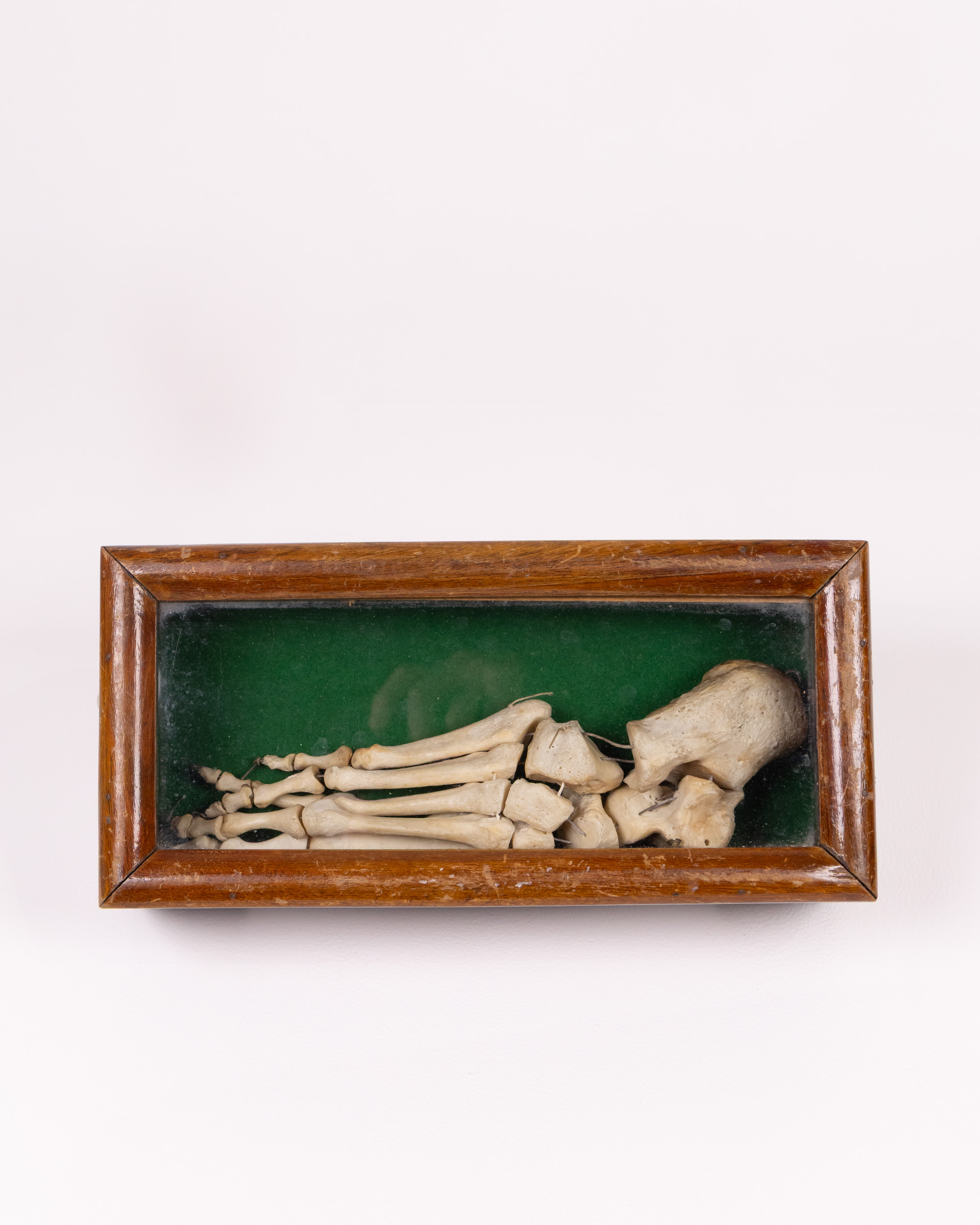 Victorian Human Bone Foot Skeleton Display with Glass Case