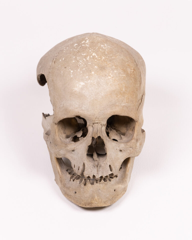 Real Human Skull with Natural Markings