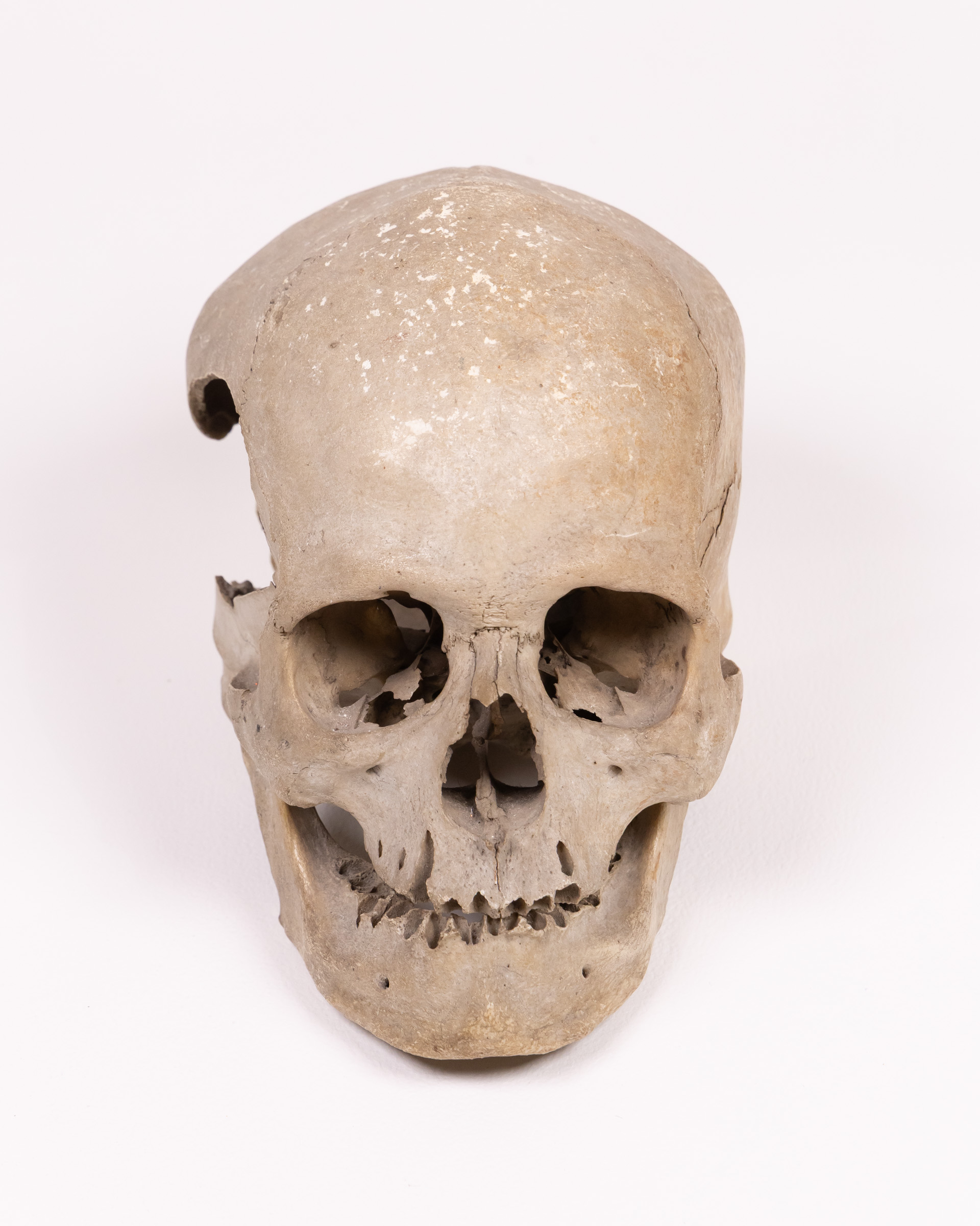 Real Human Skull with Natural Markings