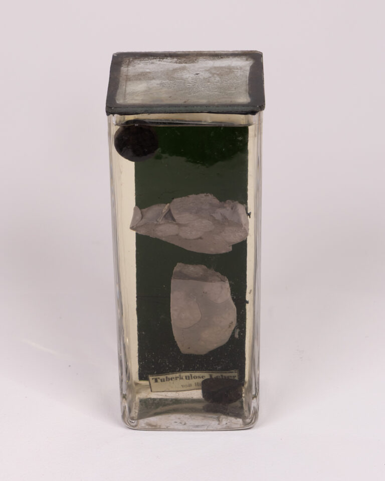Vintage Glass Tuberculosis Specimen with Original Label
