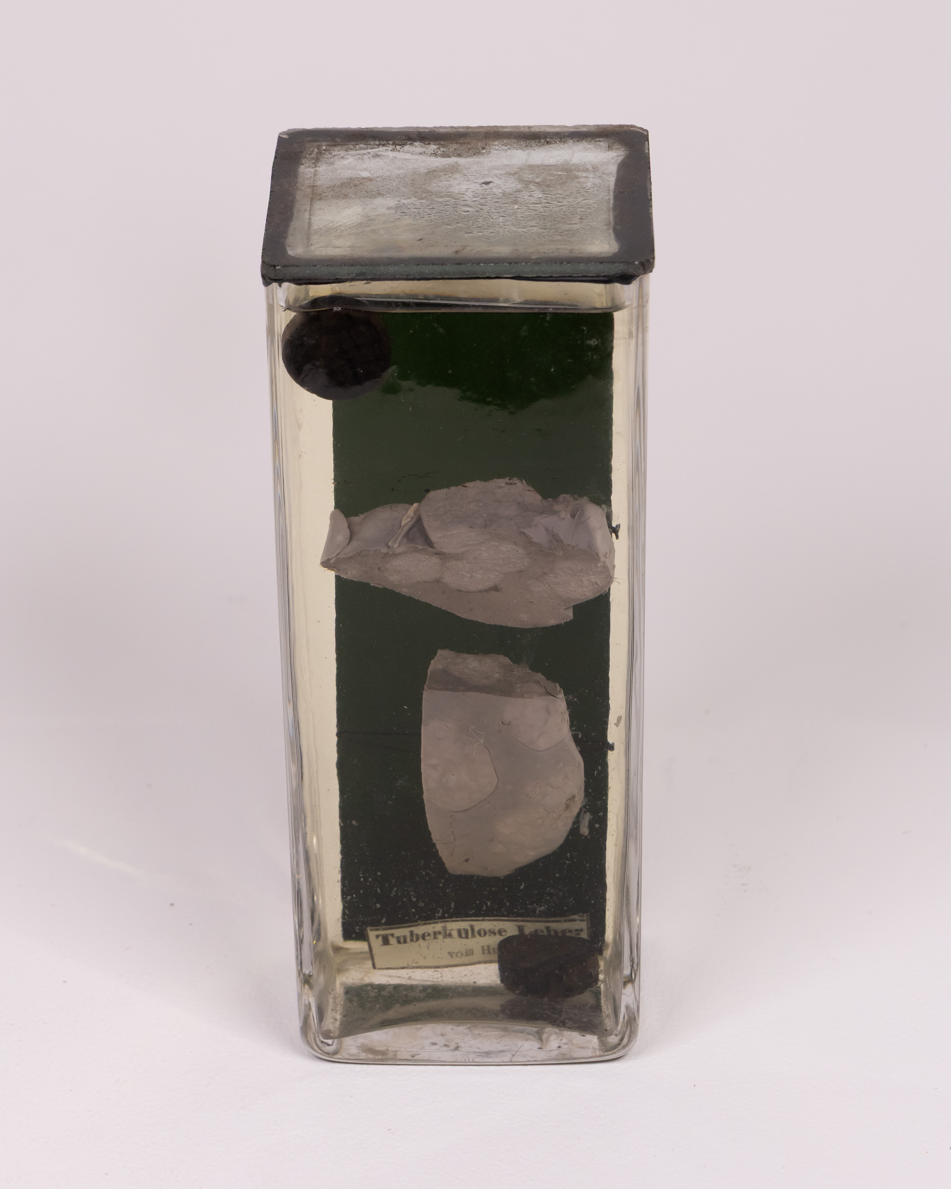 Vintage Glass Tuberculosis Specimen with Original Label