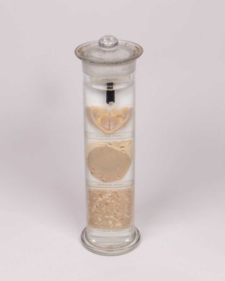 Antique Veterinary Pathology Wet Specimen — “Boubel/Uher” (Cysticercosis) of Larynx, Heart & Muscle — Czech, c.1900 (Porcine)